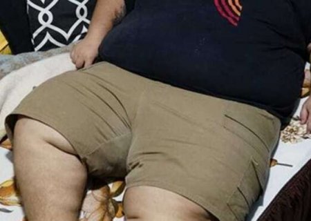Com obesidade grave, crian&ccedil;a tenta emagrecer com medicamento, mas Justi&ccedil;a nega